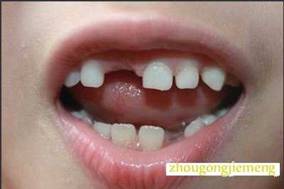 梦见牙齿掉了一颗